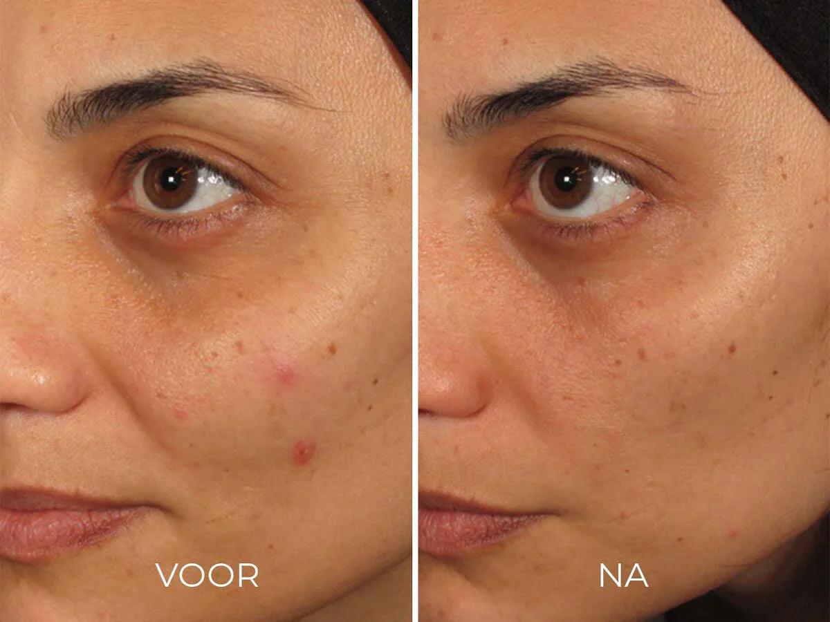 ILUMA-Intense-Facial-Illuminator-2 - K Drogerie